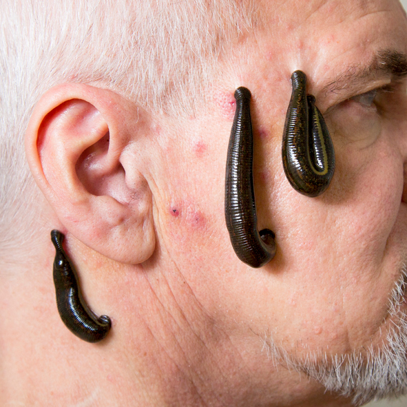 Leech therapy