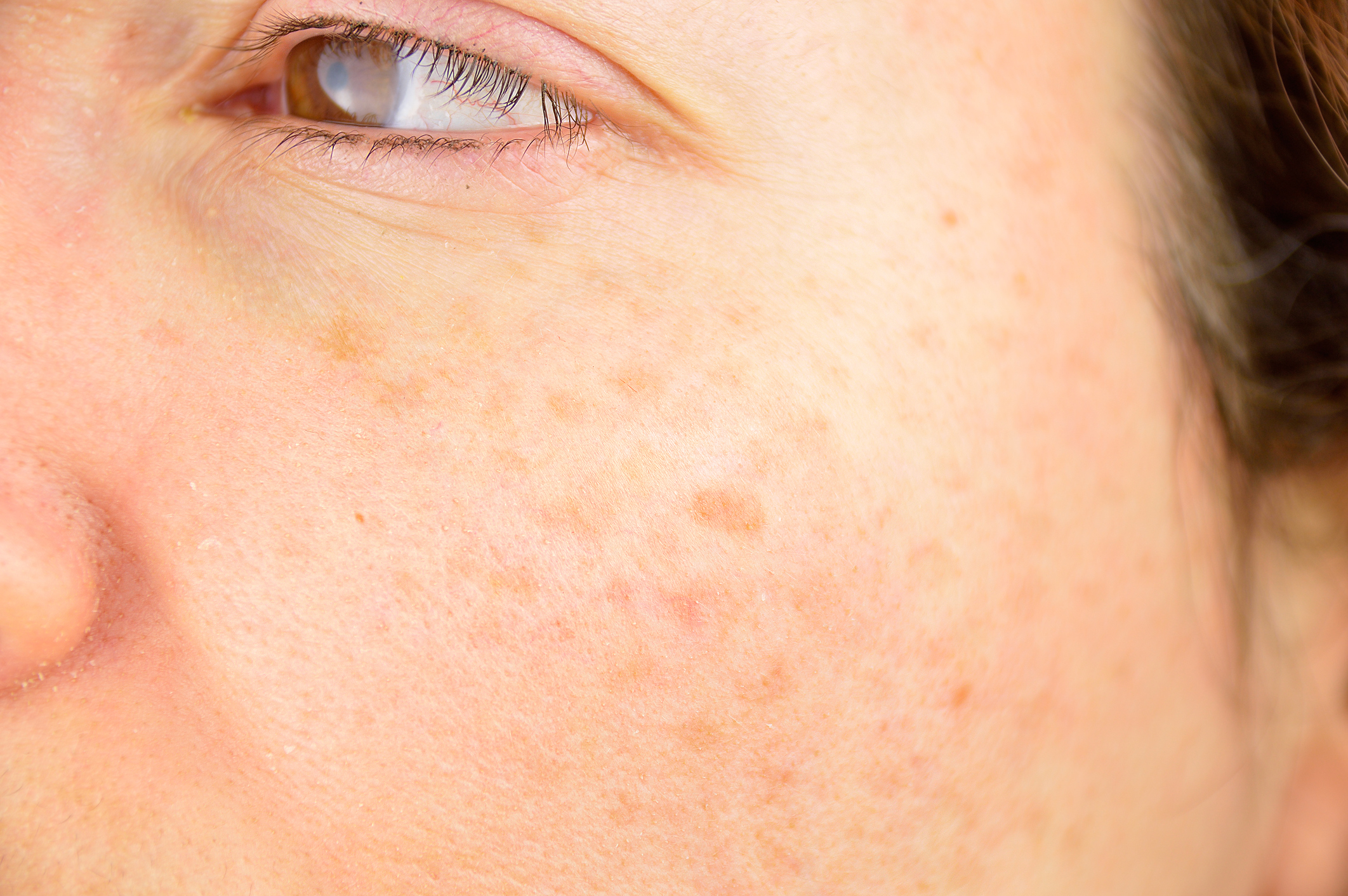 skin of woman with blemish and spots