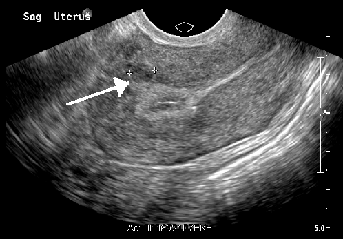UterineFirboid.png