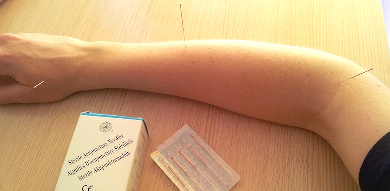 Acupuncture Acupuncture Needles