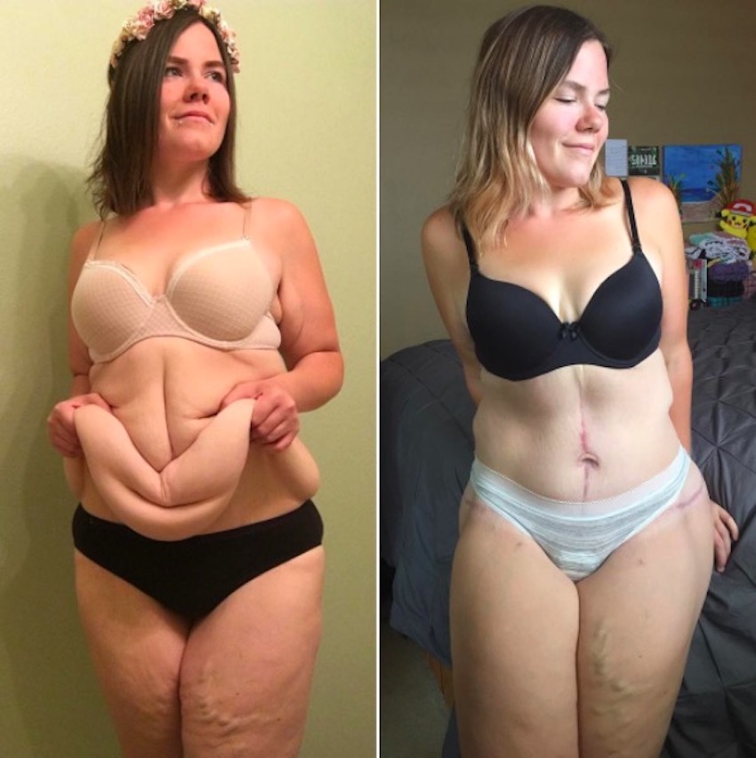 amanda-skin-removal-11.jpg