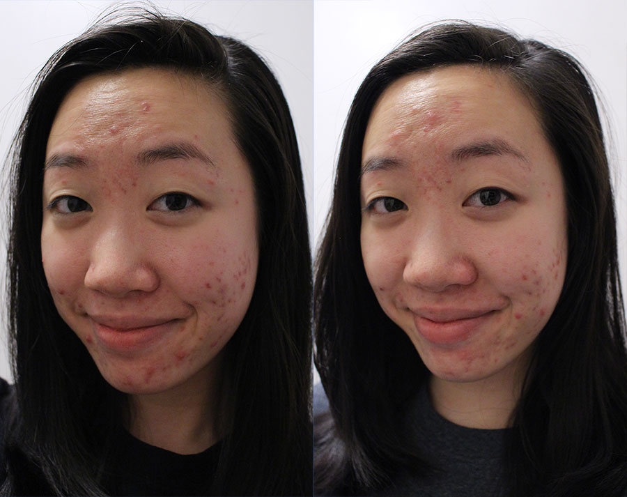 apple-cider-vinegar-for-acne-12.jpg