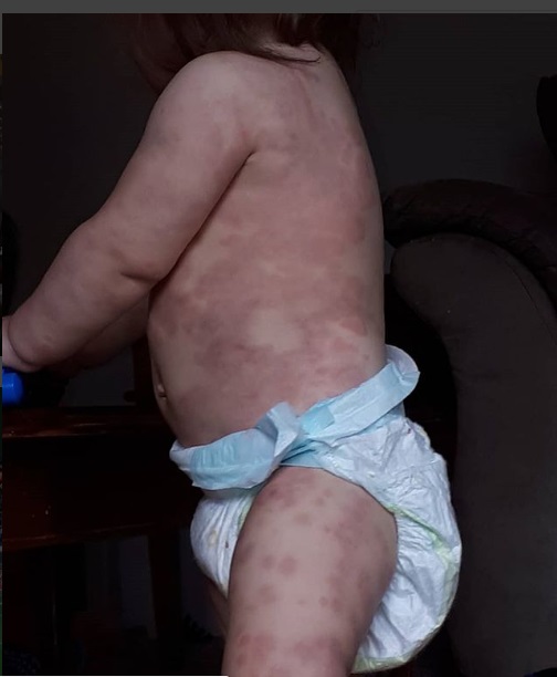 baby-rash.jpg