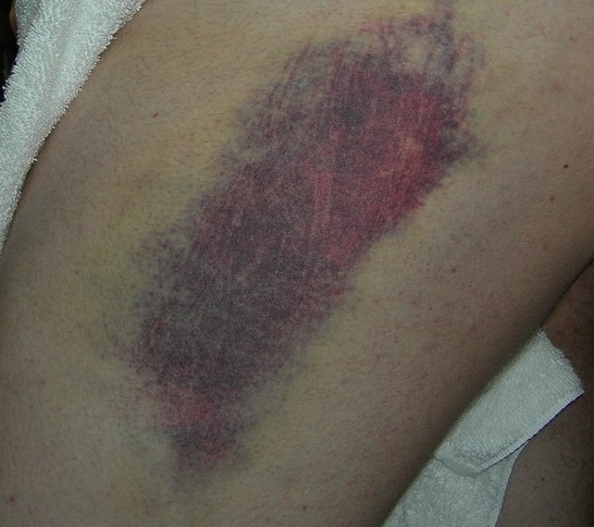 blue-bruise-e1452199923589.jpg