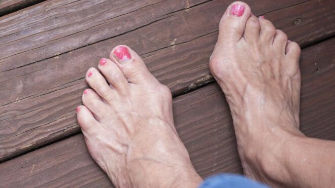 Feet with severe bunions