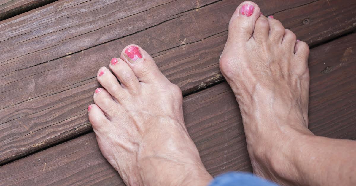 Feet with severe bunions