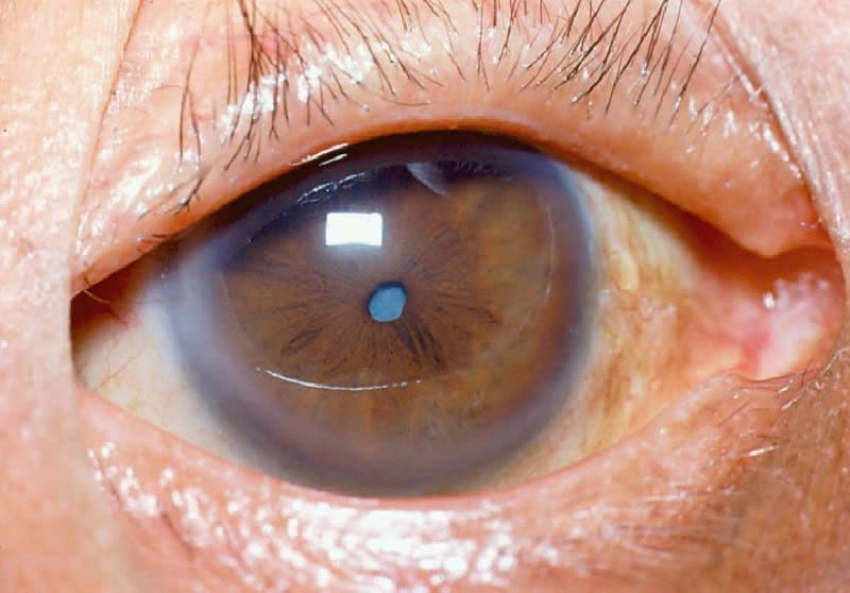 cataracts-1.jpg