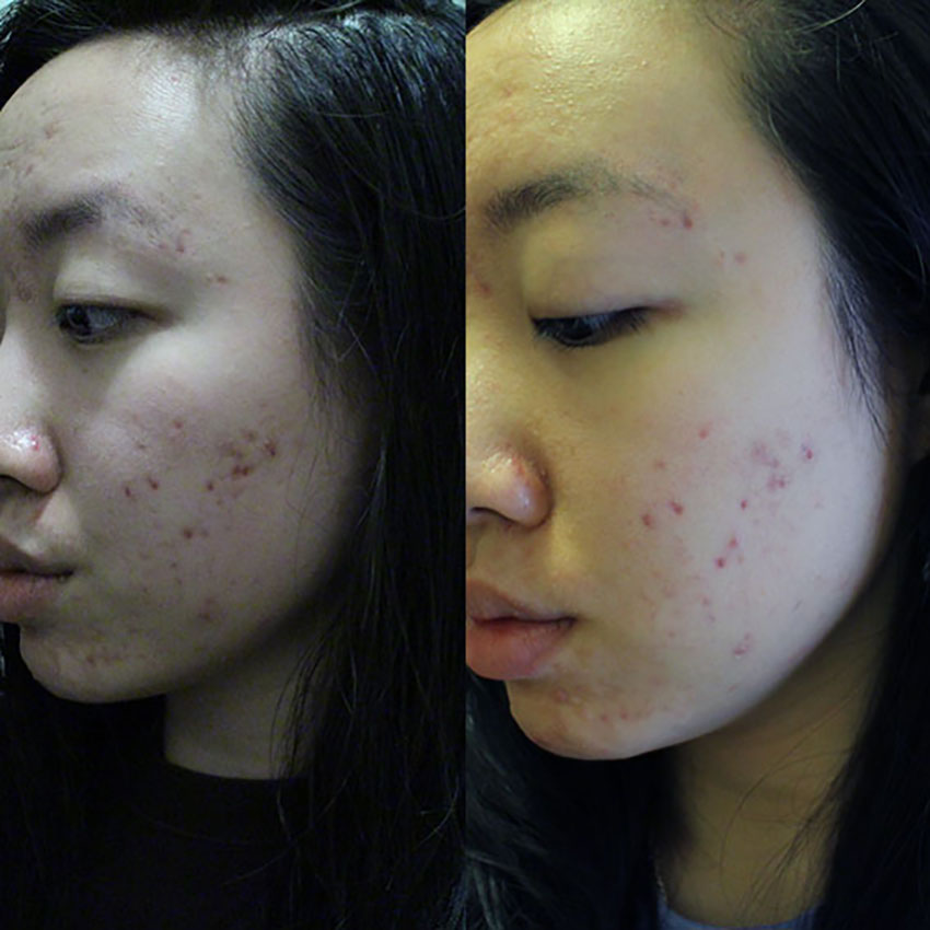 coconut-oil-for-acne-scars-12.jpg