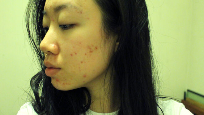 Acne Scars 1280