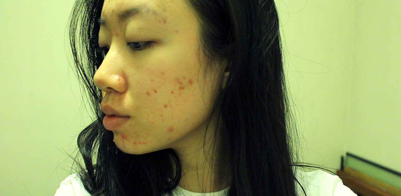 Acne Scars 1280