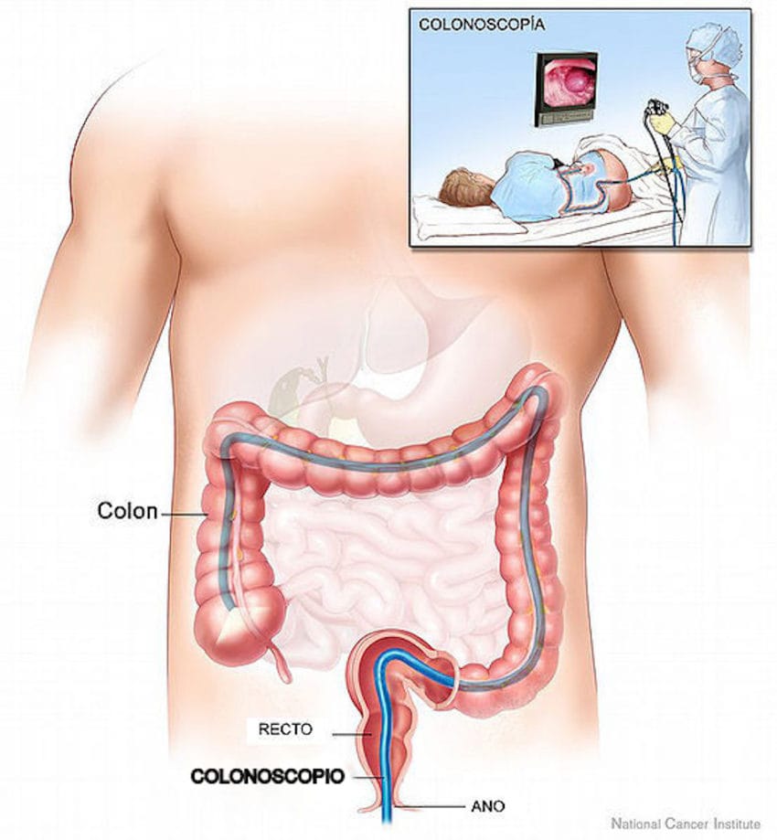 colonoscopy-850x919-1.jpg