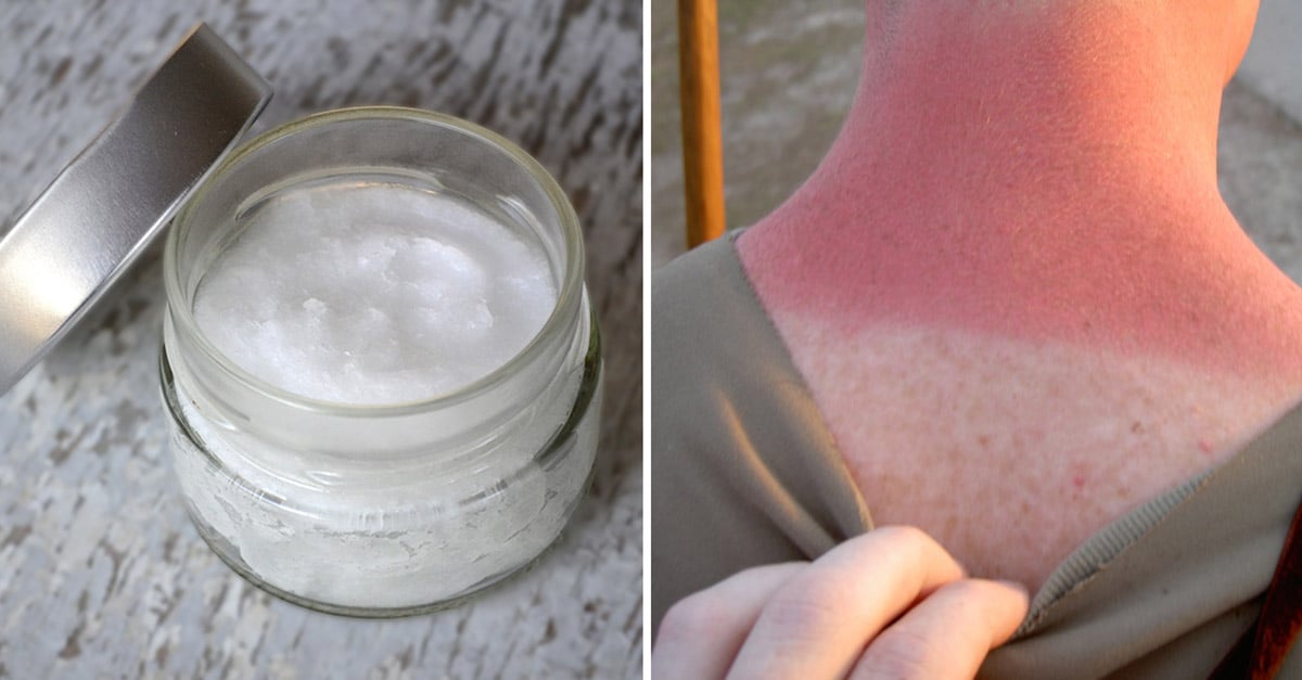 Coconut Oil Does Help Sunburn — If Used Properly