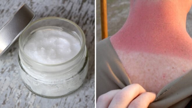 Does Coconut Oil Help Sunburn