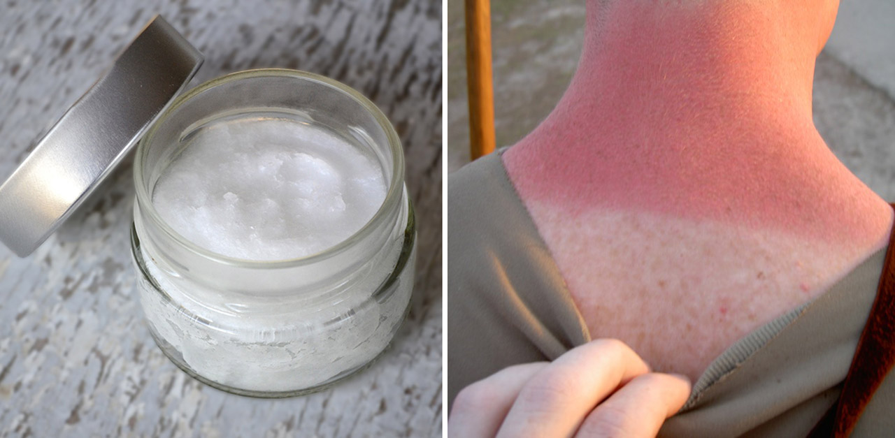 Does Coconut Oil Help Sunburn