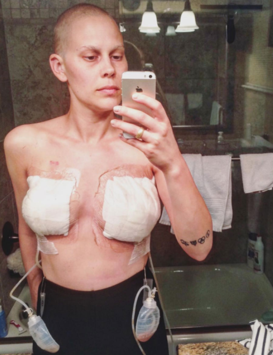 double-mastectomy-1.jpg