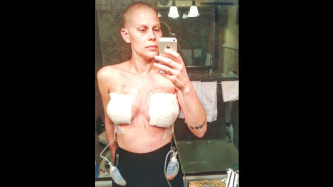 double-mastectomy-scars