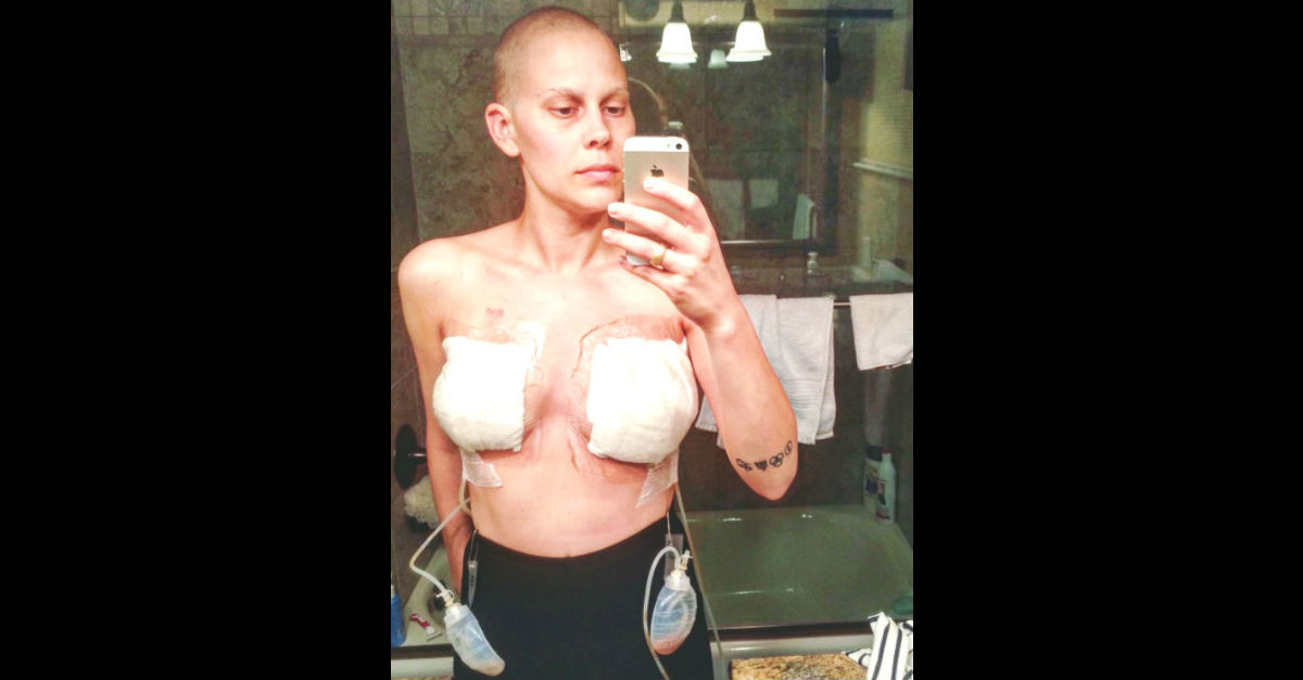 double-mastectomy-scars