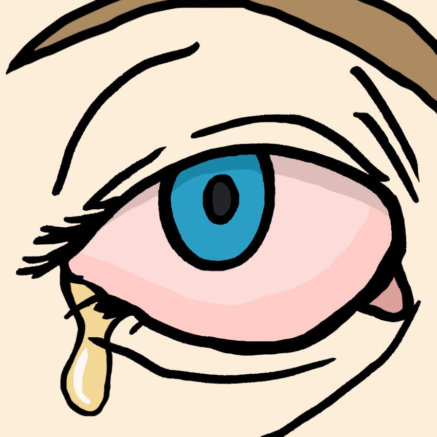 embeddedIMG_All-NaturalRemediesForPinkeye_850px_2.jpg
