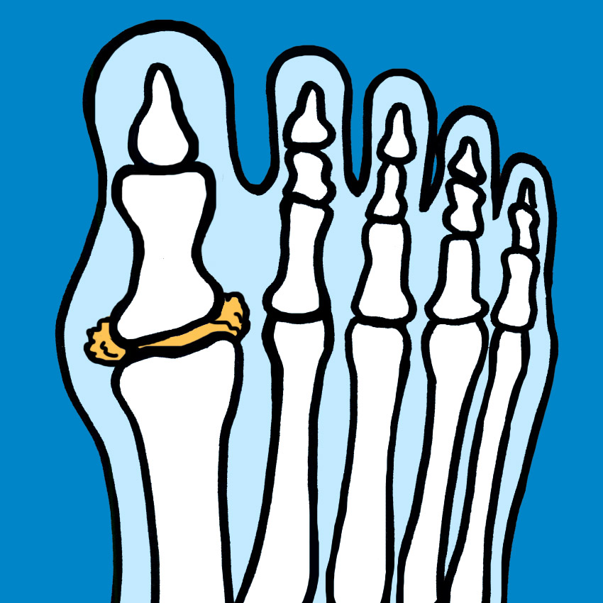 embeddedIMG_AllAboutGout-WhatYouNeedToKnowAboutIdentifyingAndTreatingIt_850px_1.jpg embeddedIMG_AllAboutGout-WhatYouNeedToKnowAboutIdentifyingAndTreatingIt_850px_1.jpg