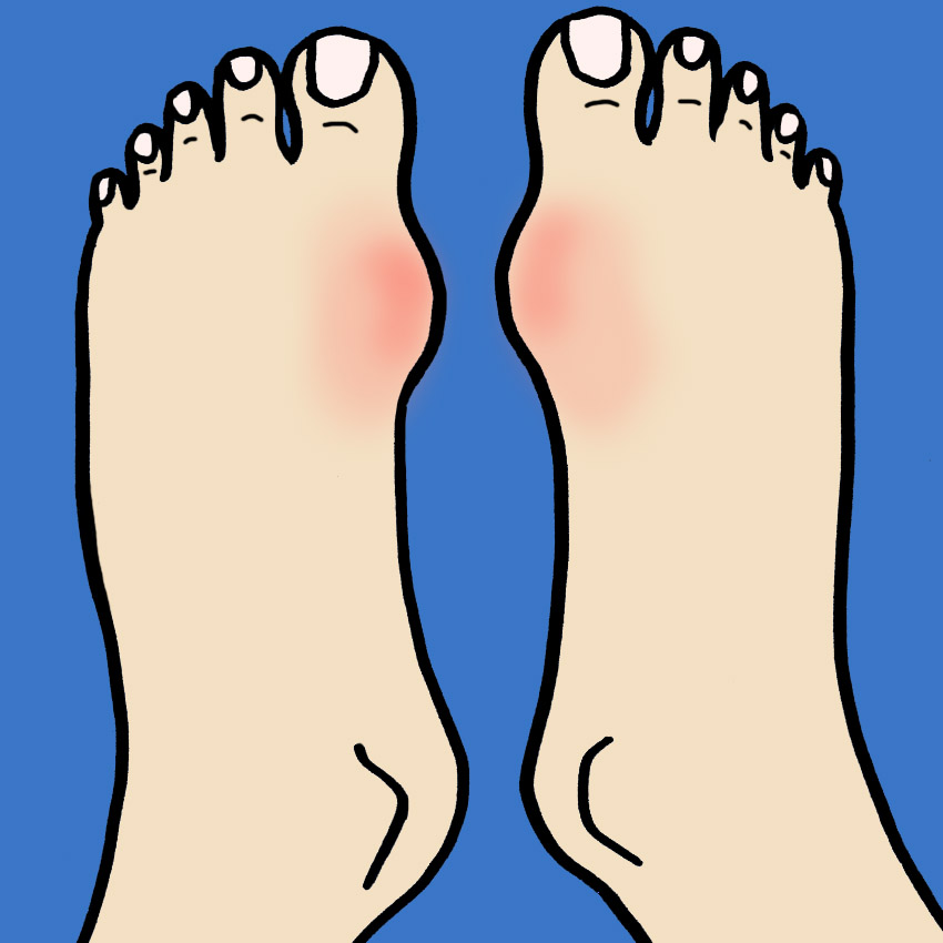 embeddedIMG_AllAboutGout-WhatYouNeedToKnowAboutIdentifyingAndTreatingIt_850px_3.jpg embeddedIMG_AllAboutGout-WhatYouNeedToKnowAboutIdentifyingAndTreatingIt_850px_3.jpg