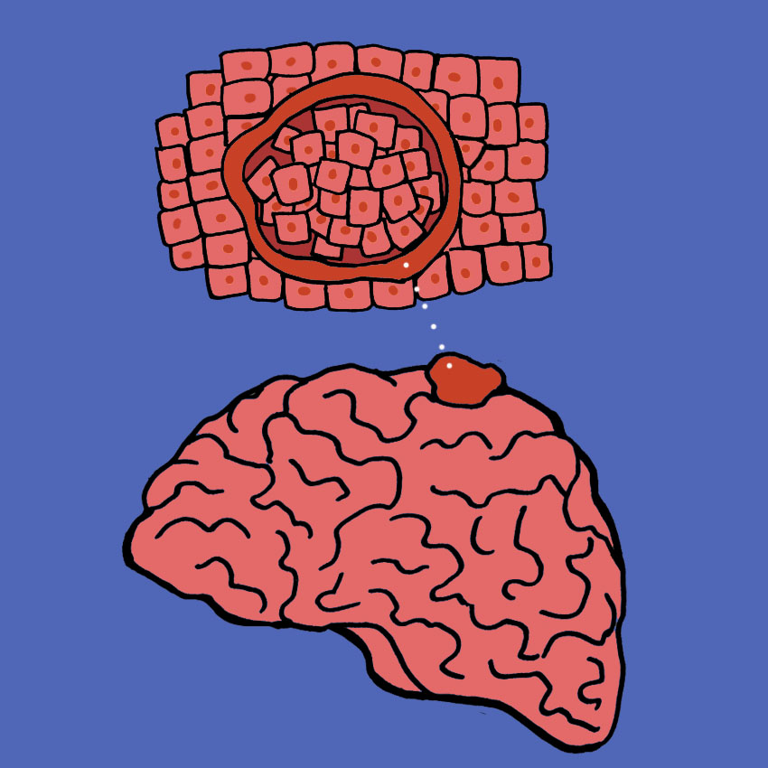 embeddedIMG_CommonSymptomsOfABenignMeningioma_850px_2.jpg