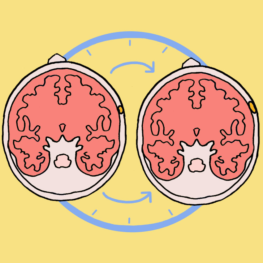 embeddedIMG_CommonSymptomsOfABenignMeningioma_850px_4.jpg