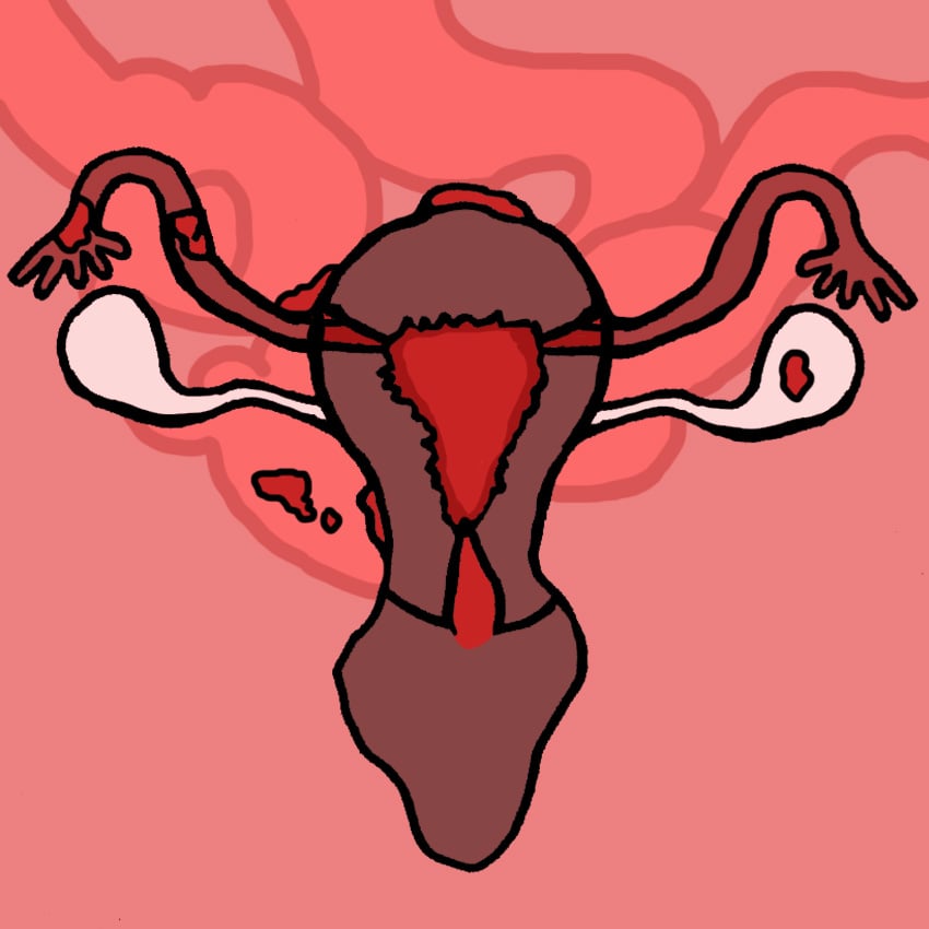 embeddedIMG_Endometriosis-WhenItsWayMoreThanJustCramps_850px_1.jpg