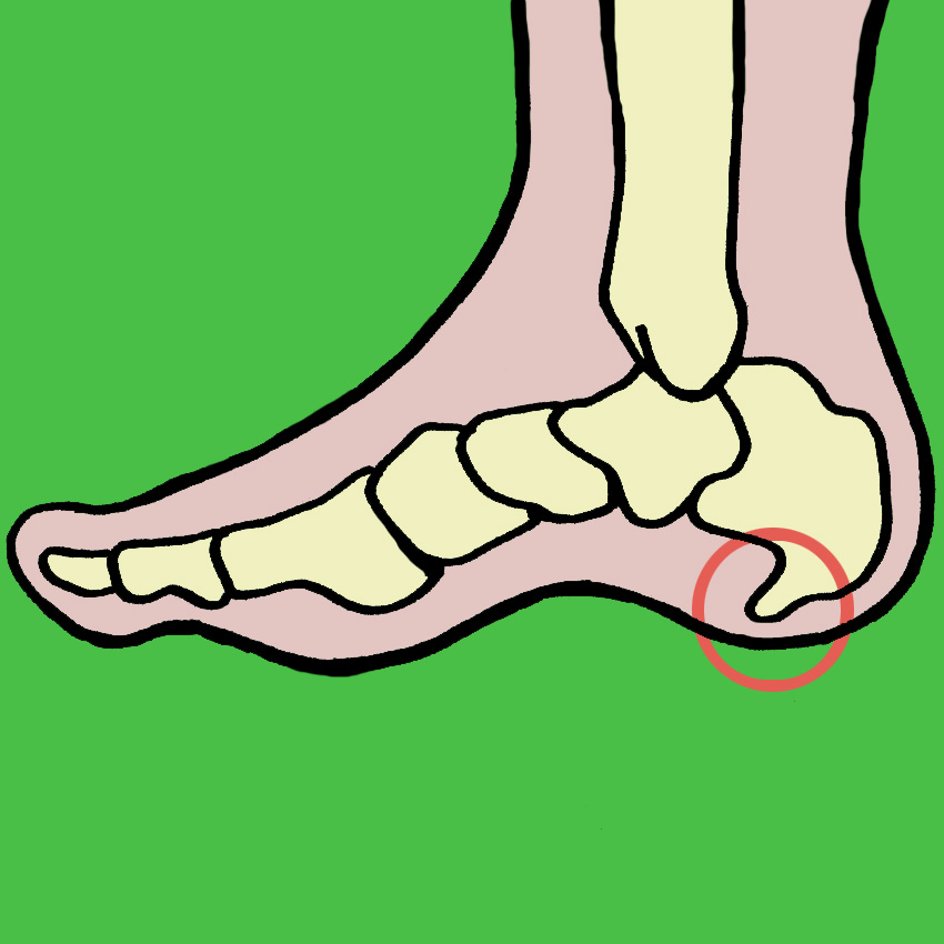 embeddedIMG_HeelSpurs-SurprisingCausesAndAt-HomeTreatments_850px_1.jpg
