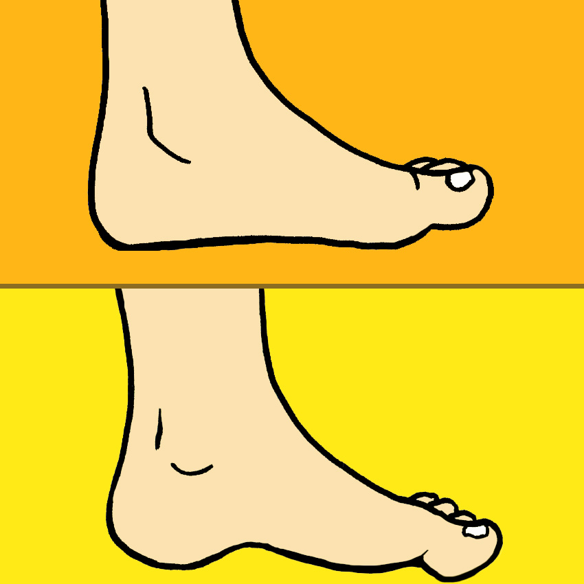 embeddedIMG_HeelSpurs-SurprisingCausesAndAt-HomeTreatments_850px_3.jpg