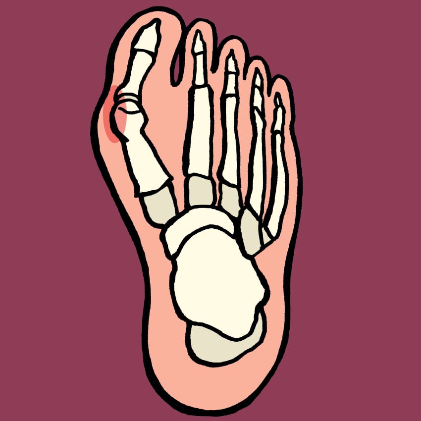 embeddedIMG_ManagingBunionsAtHomeForHealthyComfyFeet_850px_1.jpg embeddedIMG_ManagingBunionsAtHomeForHealthyComfyFeet_850px_1.jpg