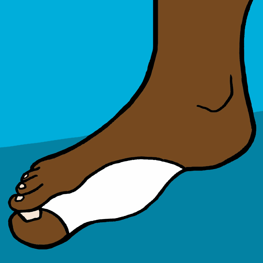 embeddedIMG_ManagingBunionsAtHomeForHealthyComfyFeet_850px_6.jpg