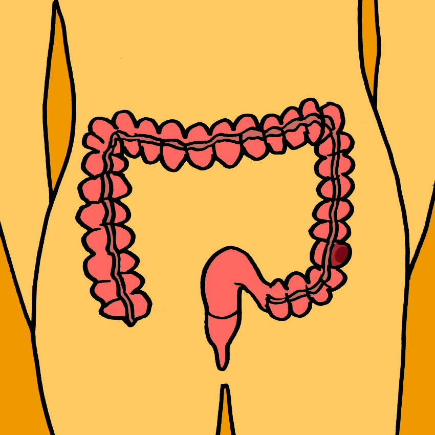 embeddedIMG_SignsOfColorectalCancer_850px_1.jpg