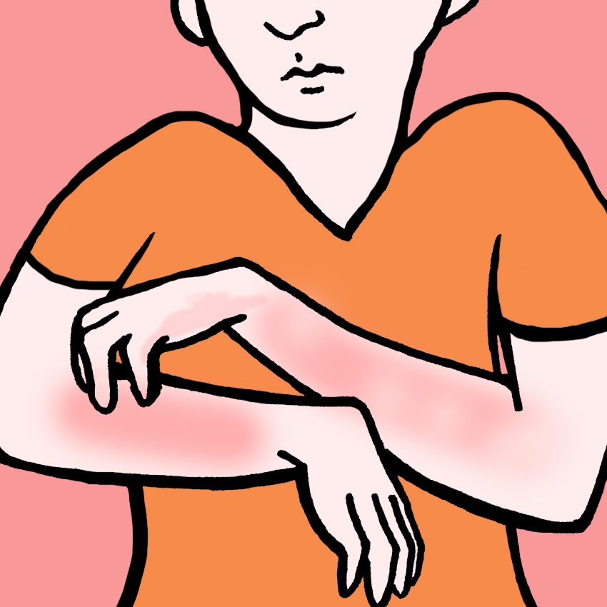 embeddedIMG_SoothingEczemaAtHomeWithSimpleEasyRemedies_850px_1.jpg