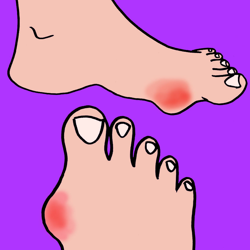 embeddedIMG_SymptomsOfBunions_850px_4.jpg