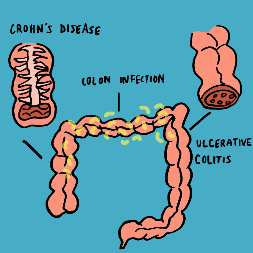 embeddedIMG_SymptomsOfToxicMegacolon_850px_2.jpg