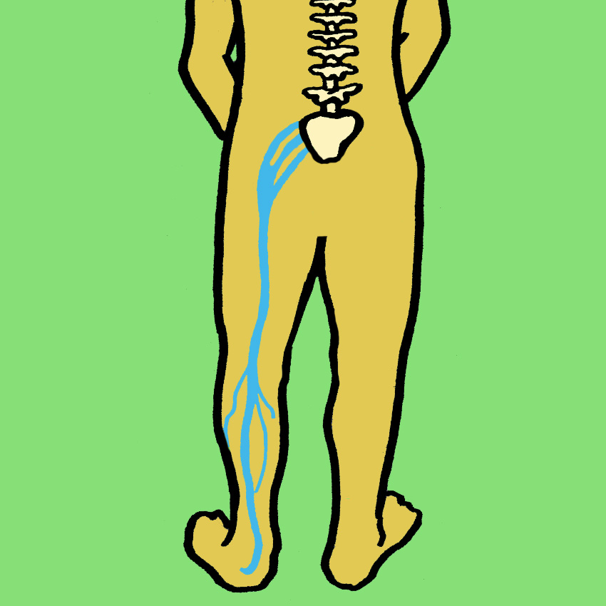 embeddedIMG_UnderstandingAndManagingSciaticaAndSciaticPain_850px_1.jpg
