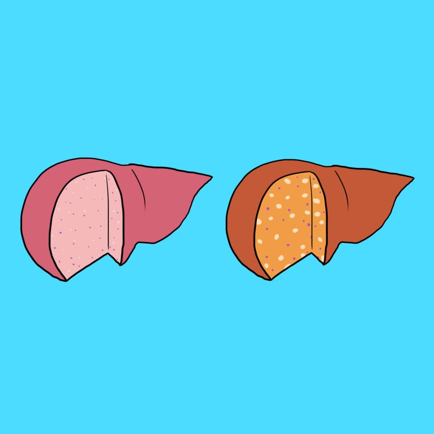 embeddedIMG_fattyliver_850px_1.jpg embeddedIMG_fattyliver_850px_1.jpg
