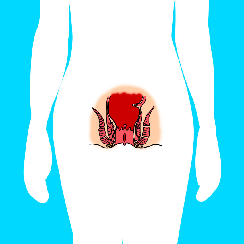 embeddedIMG_reasonsforbloodinyourstool_850px_1_-1.jpg embeddedIMG_reasonsforbloodinyourstool_850px_1_-1.jpg