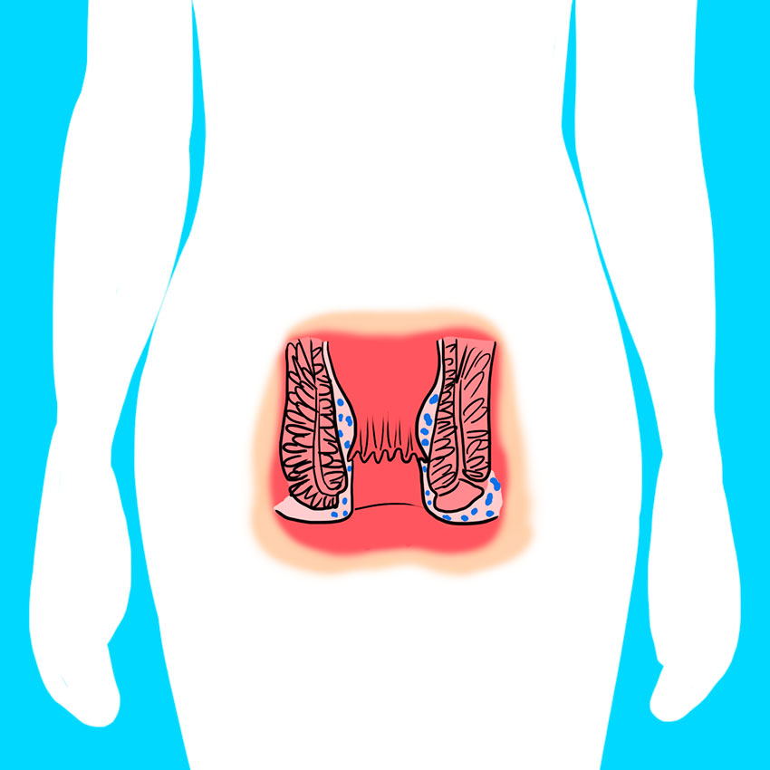 embeddedIMG_reasonsforbloodinyourstool_850px_4_-1.jpg embeddedIMG_reasonsforbloodinyourstool_850px_4_-1.jpg