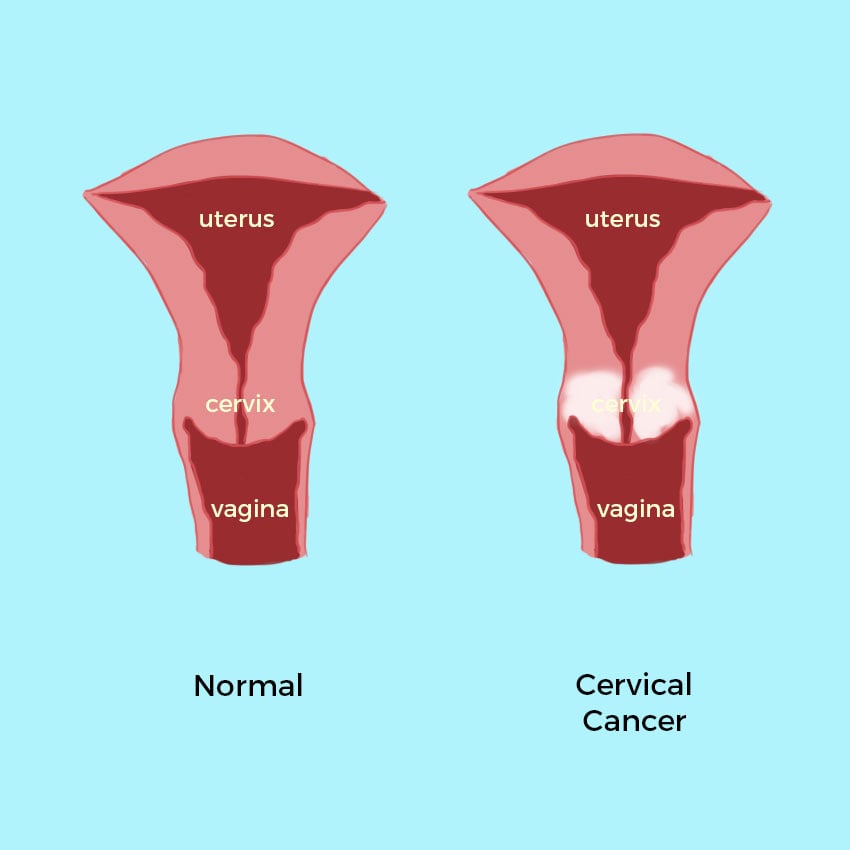 cervical cancer symptoms