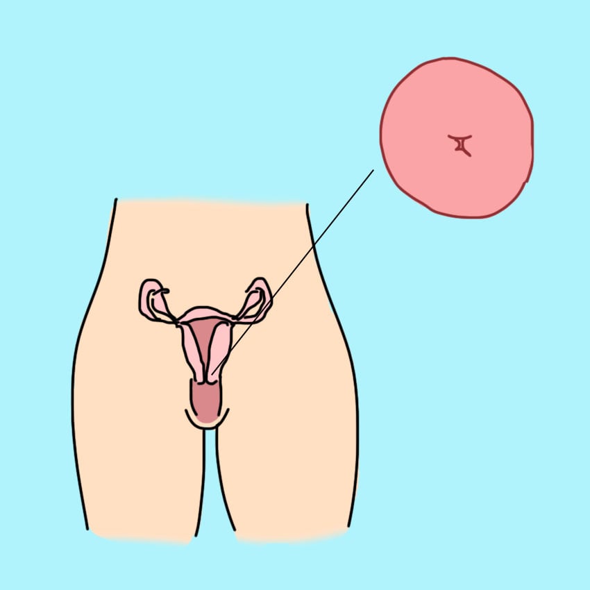 cervical cancer symptoms