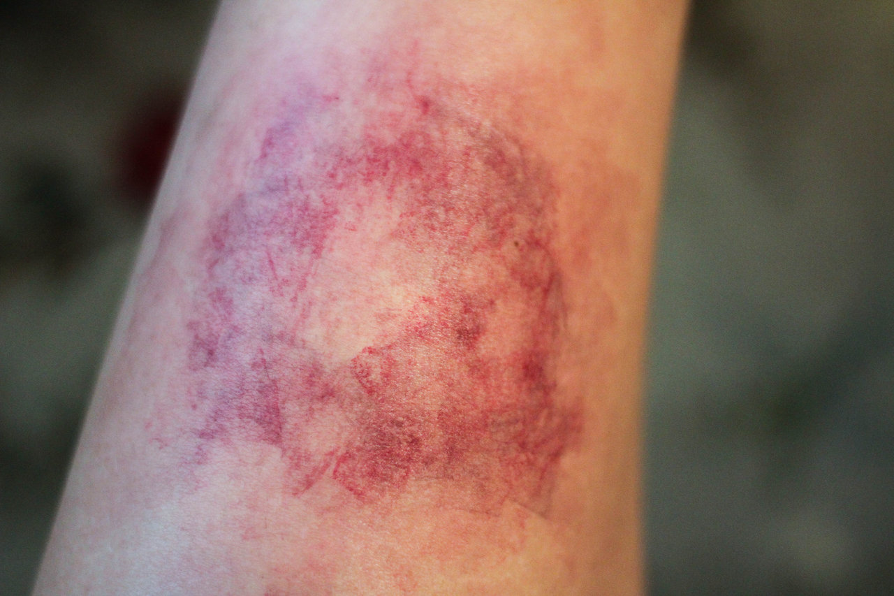 fresh_bruise_by_freakmo_sfx-d60zc791.jpg