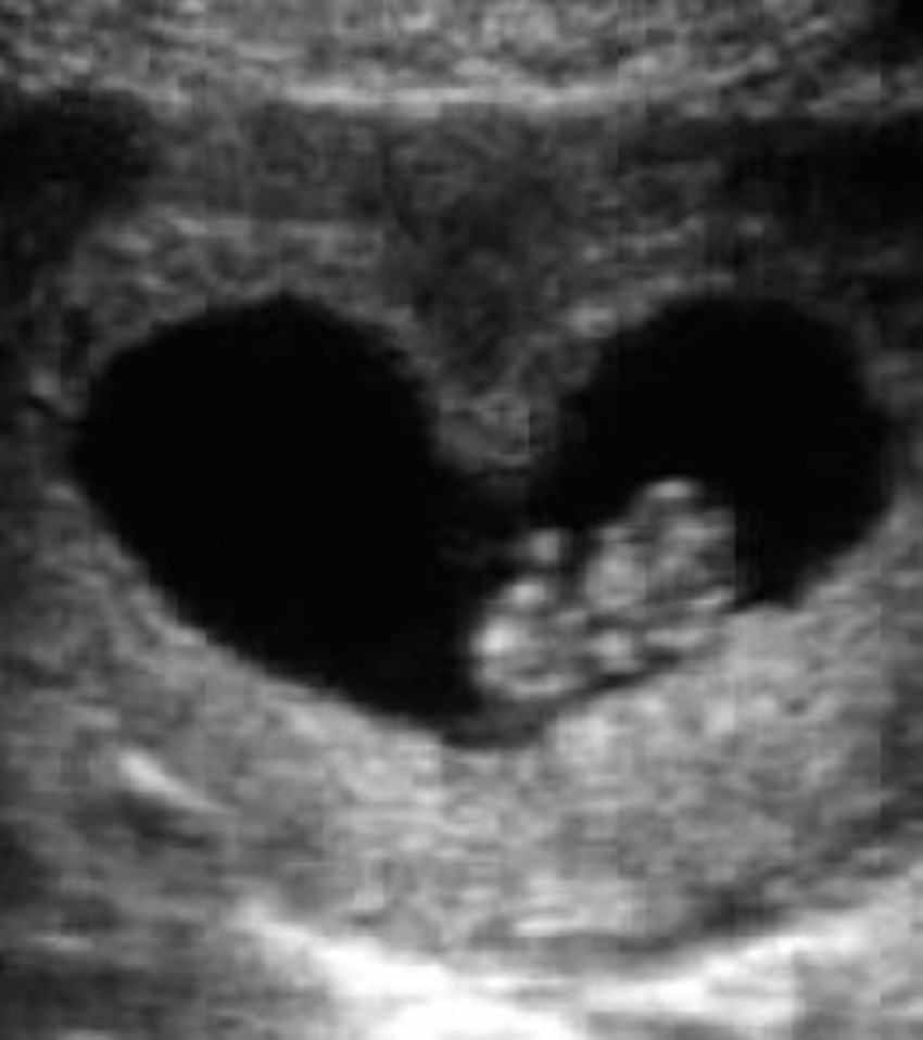 heart-shaped-uterus-e1266166849255.jpg