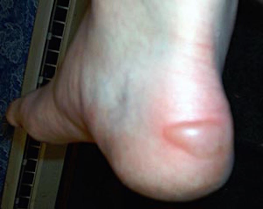 heel_blister.jpg