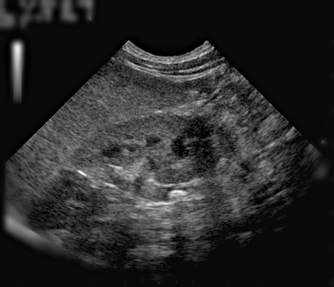 kidney_ultrasound_fixed.jpg