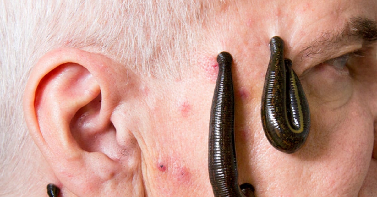 Leech therapy