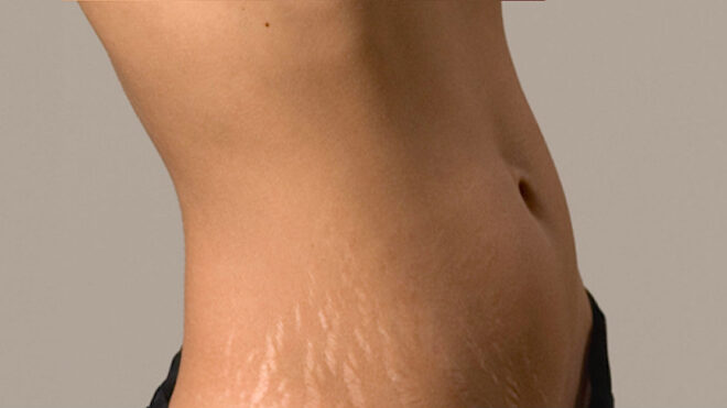 microdermabrasion-stretch-marks copy