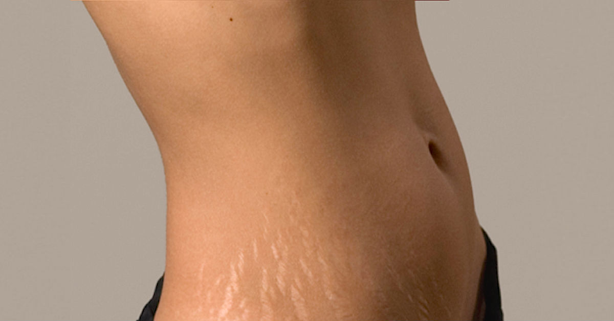 microdermabrasion-stretch-marks copy