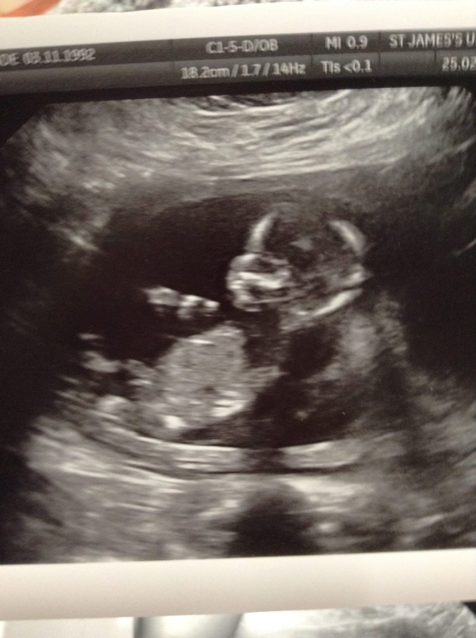 miscarriage-2.jpg