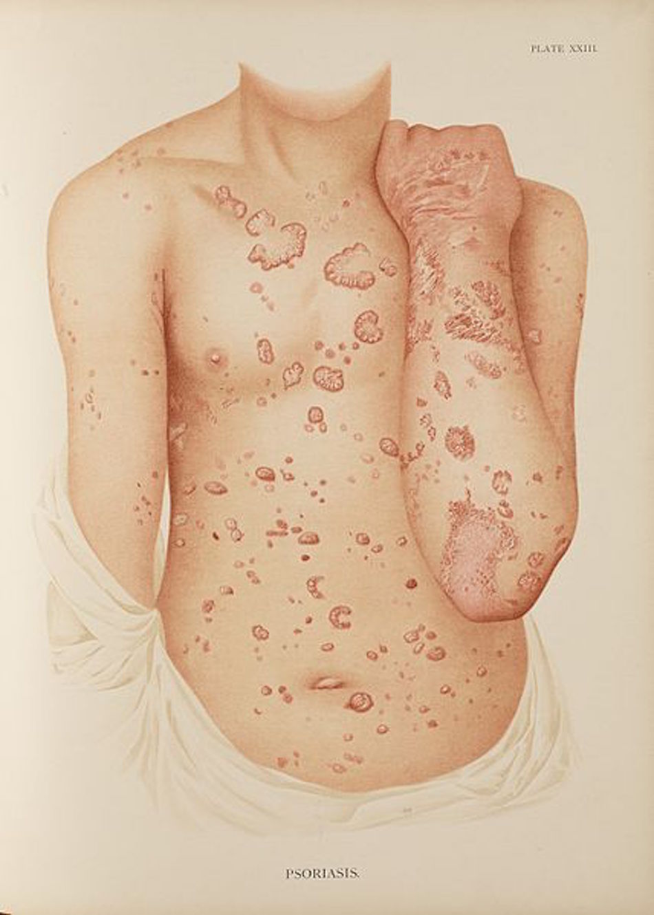 psoriasis-1.jpg